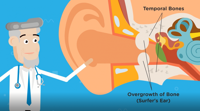 What Is Surfers Ear Infection Kitekahunas Surfers Ear Medical